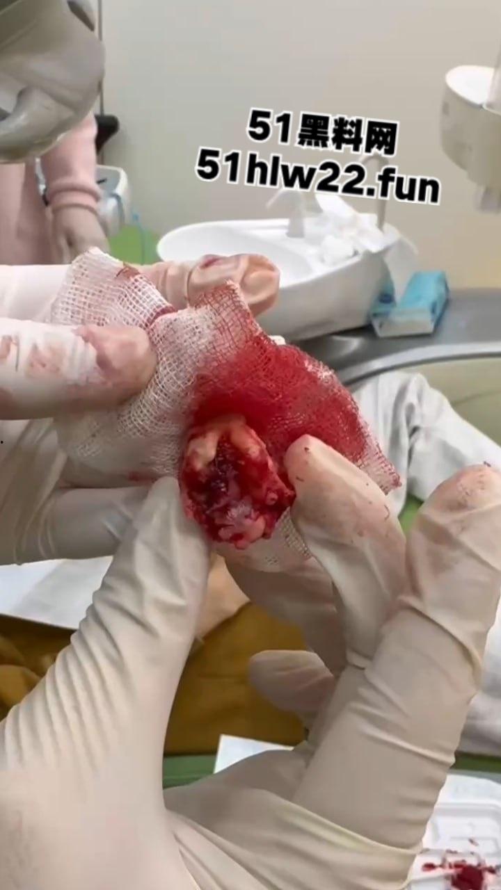 口腔医院逆天操作，客人拔智齿结果医生不分青红皂白直接大力出奇迹， 把上颌骨拔断撤了下来！