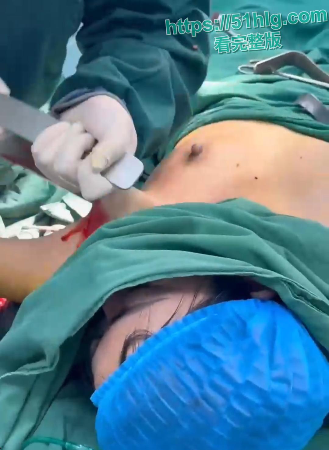 隆胸整形手术现场震惊你的眼球！平乳妹秒变巨乳御姐，女人为变美， 对自己真的太狠了