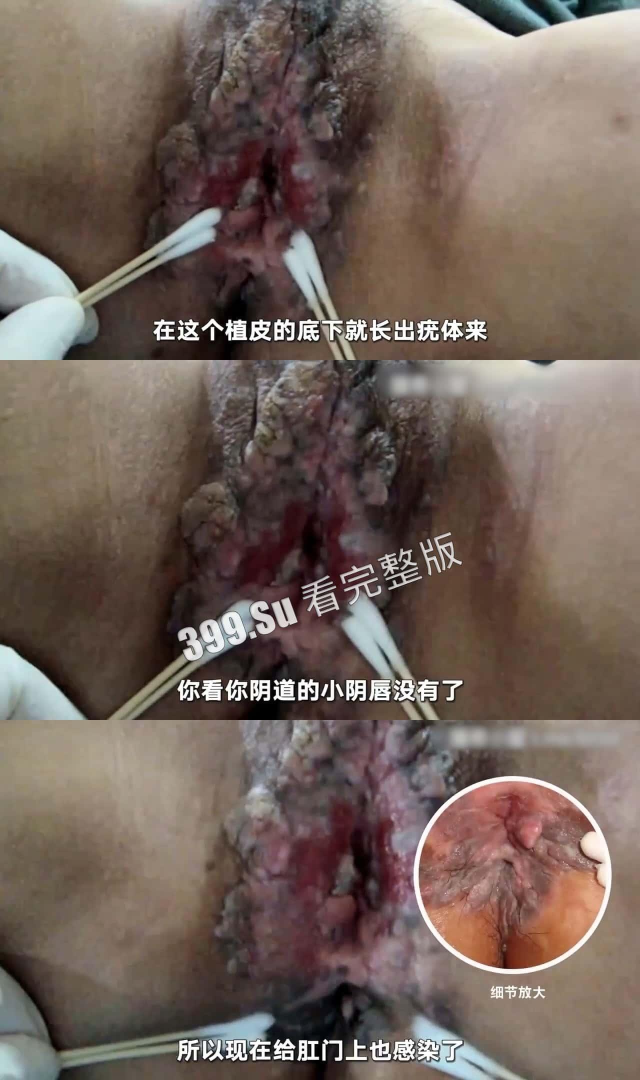 性病篇  谨慎观看！瓜友们出门在外 一定得洁身自爱 世界上没有后悔药  安全第一！！！