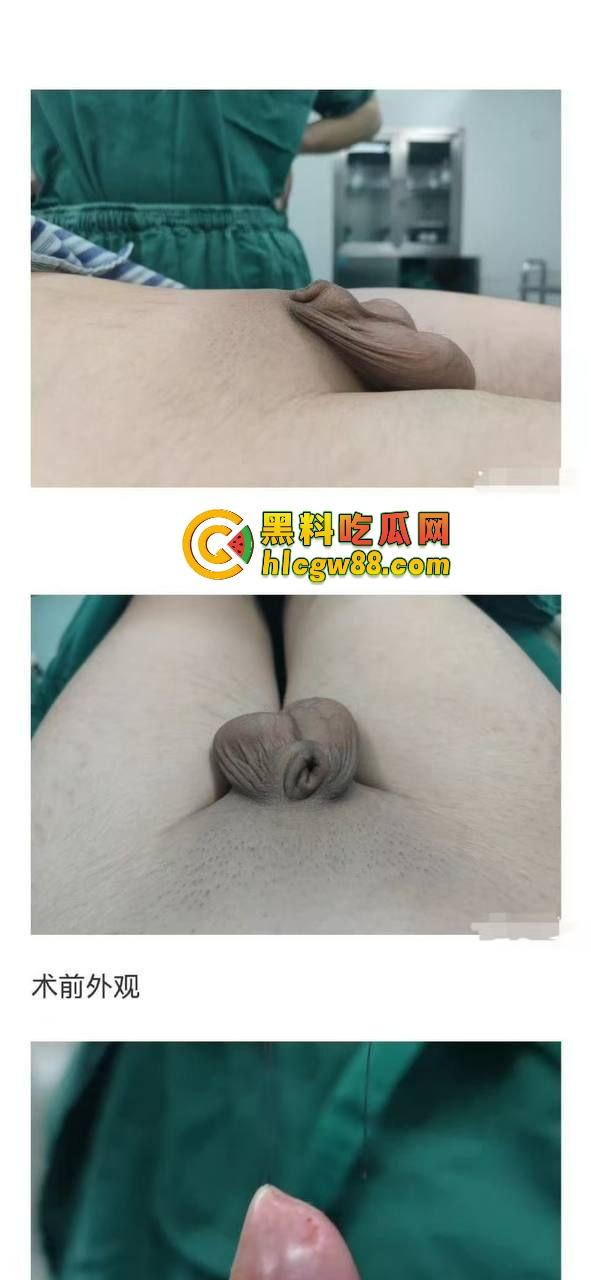 小鸟变大雕换炮计划！阴茎增大手术震撼实测 9CM秒变18CM战神之枪 ，这根真的压不住了！