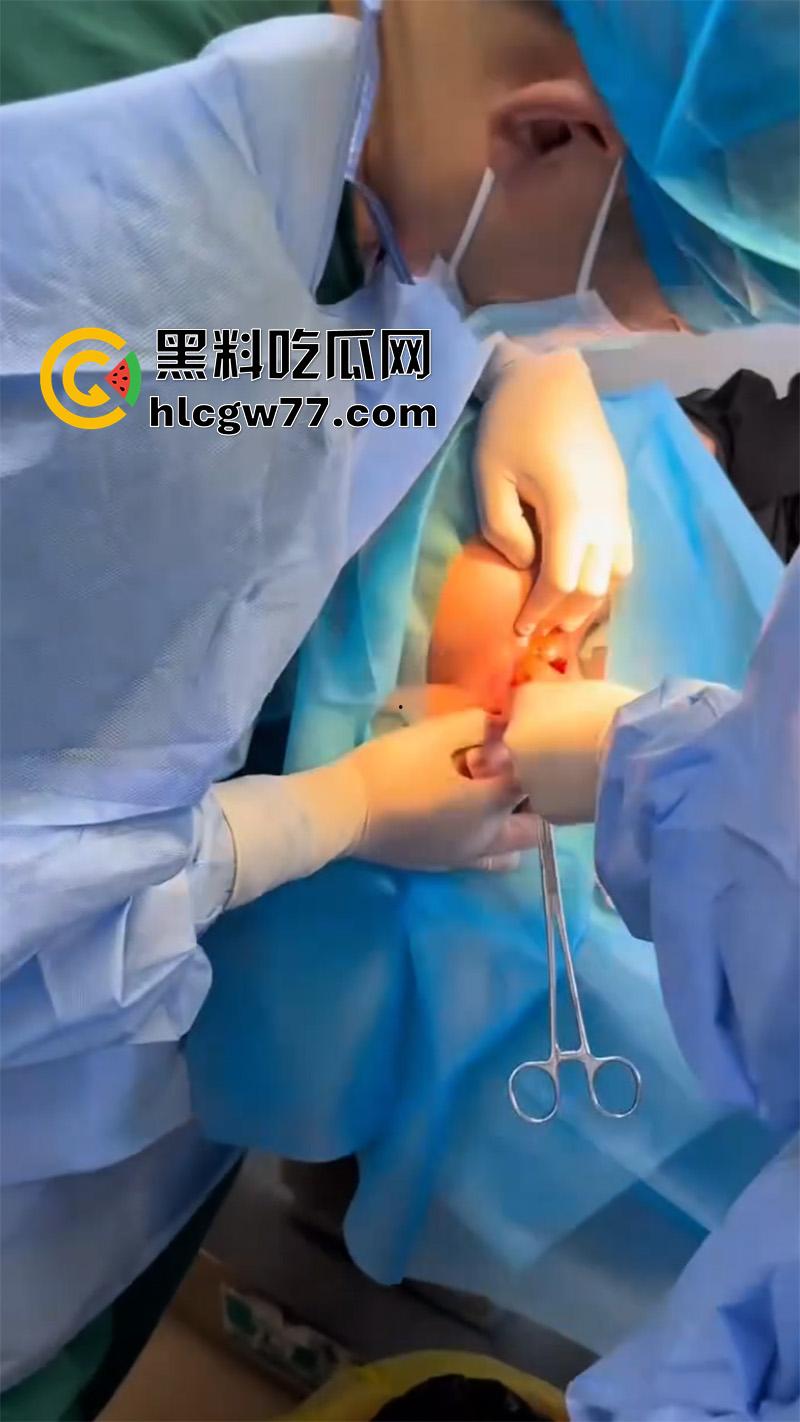 成都肛肠科又来新活，巨屌玩具塞入菊花拔不出来，只能到医院取出，这么大怎么塞进去的呢？